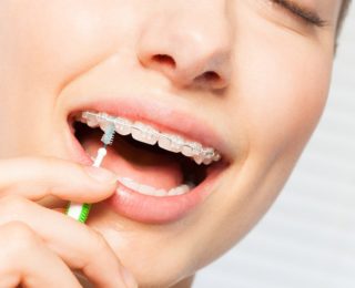 Appareil fixe et hygiène bucco-dentaire